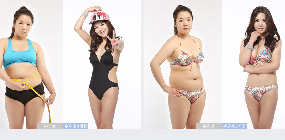 대용량지방흡입5